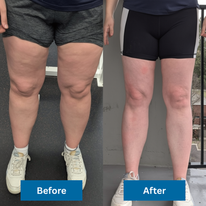 fevon Pneumatic Compression System