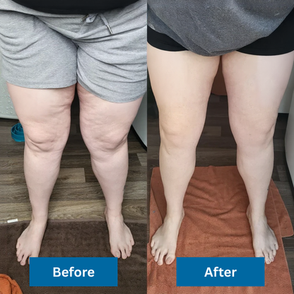 fevon Pneumatic Compression System